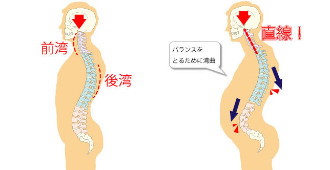 ストレートネック